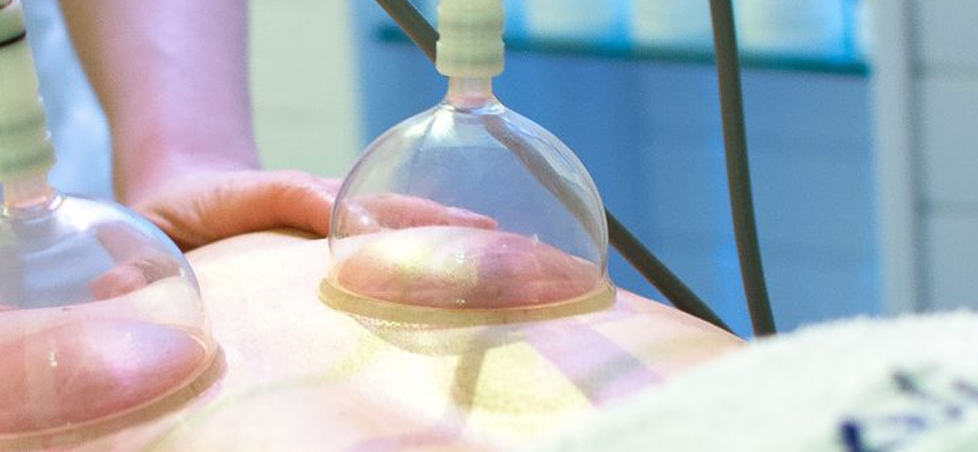 Técnica de Cupping en eliveli men