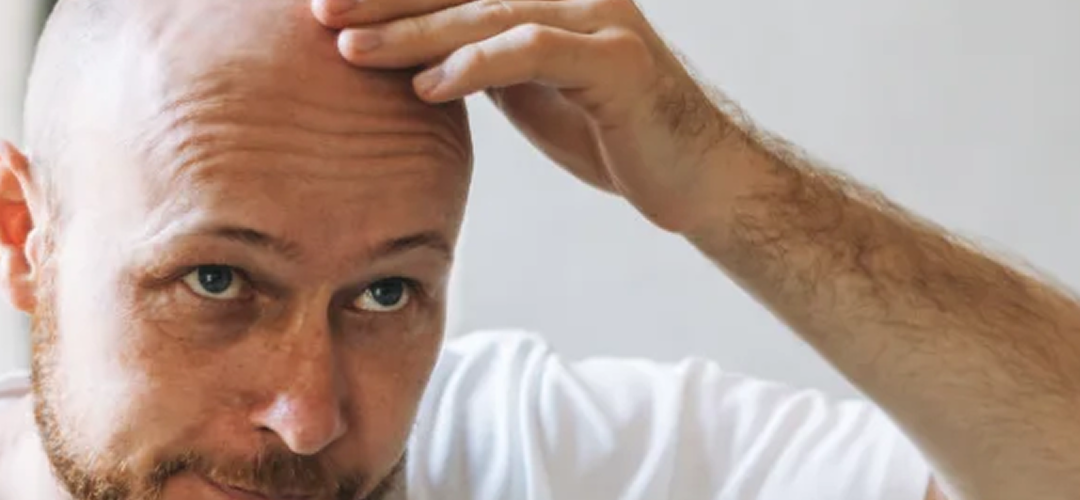 ¿Por qué se cae el pelo?