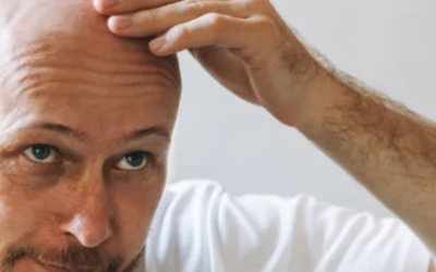 ¿Por qué se cae el pelo?